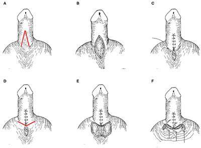 A Modified Scrotoplasty for Treating Severe Penoscrotal Webbing in Children
